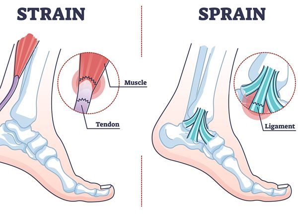 sprain